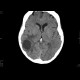 Metastatic disease of brain, lung, liver: CT - Computed tomography